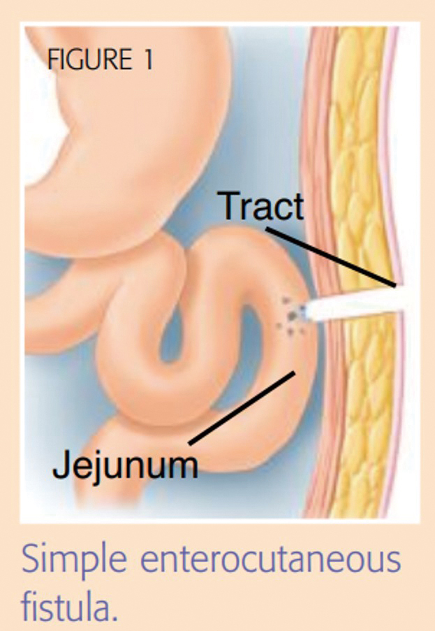 圖片來源httpswwwwoundscanadaca